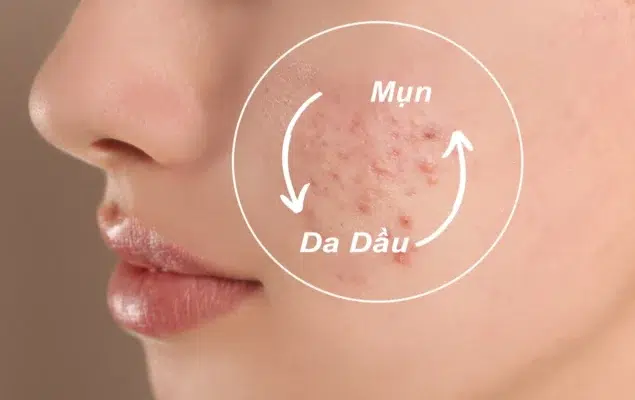 da dầu mụn nên dùng sữa rửa mặt nào tốt